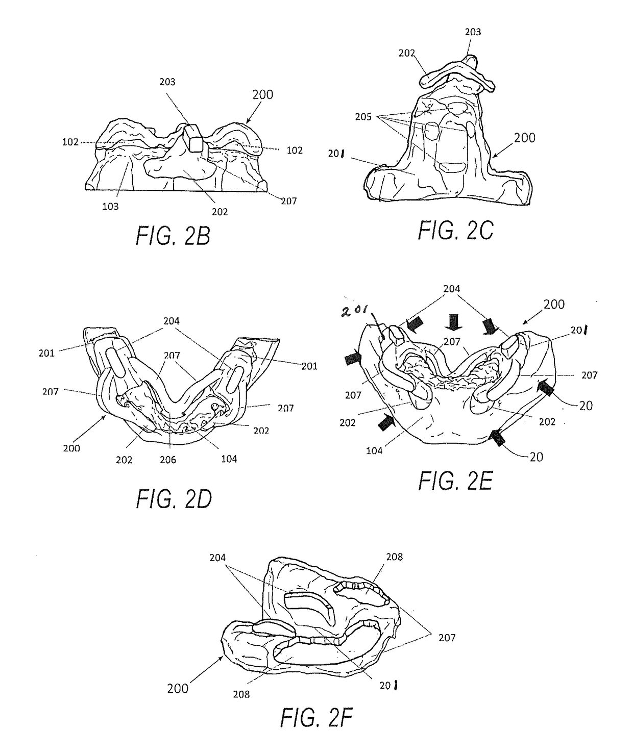 Method of using an endentulous surgical guide