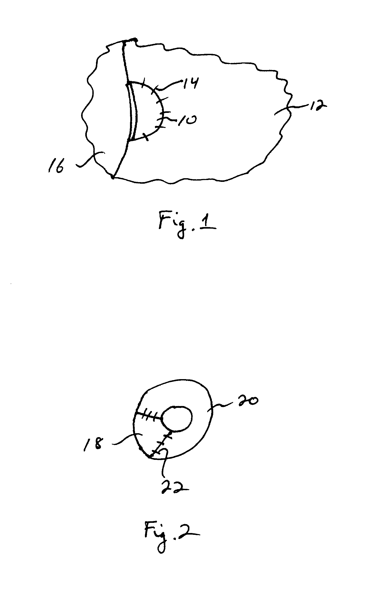 Resorbable extracellular matrix containing collagen I and collagen II for reconstruction of cartilage