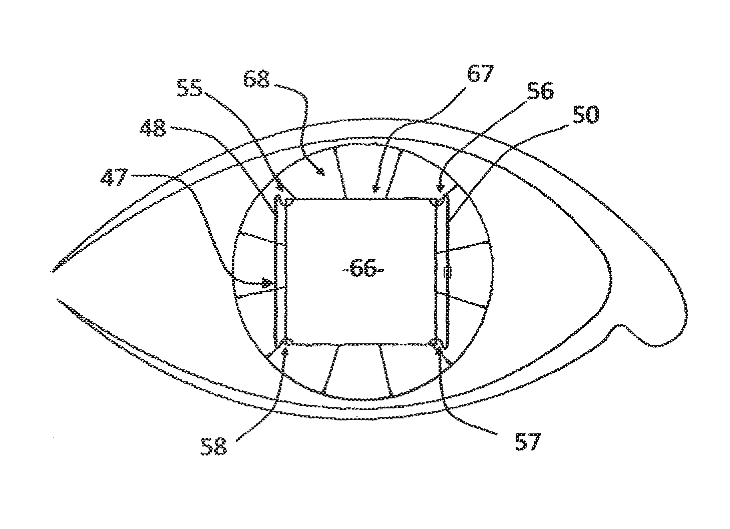 Pupil expansion device