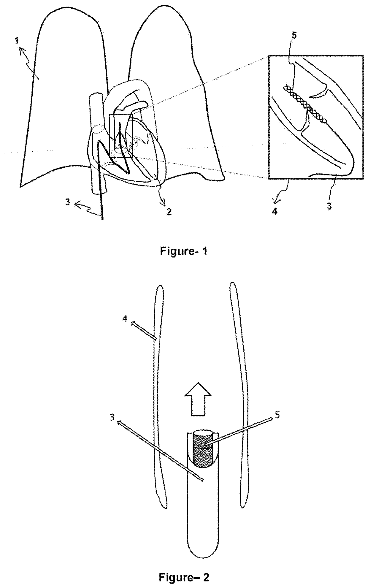 An additional improvement in management of thromboembolism risk that may be caused by a medical device being inserted intravascularly and providing protection against pulmonary hypertension risk in treatment of patients with heart defect