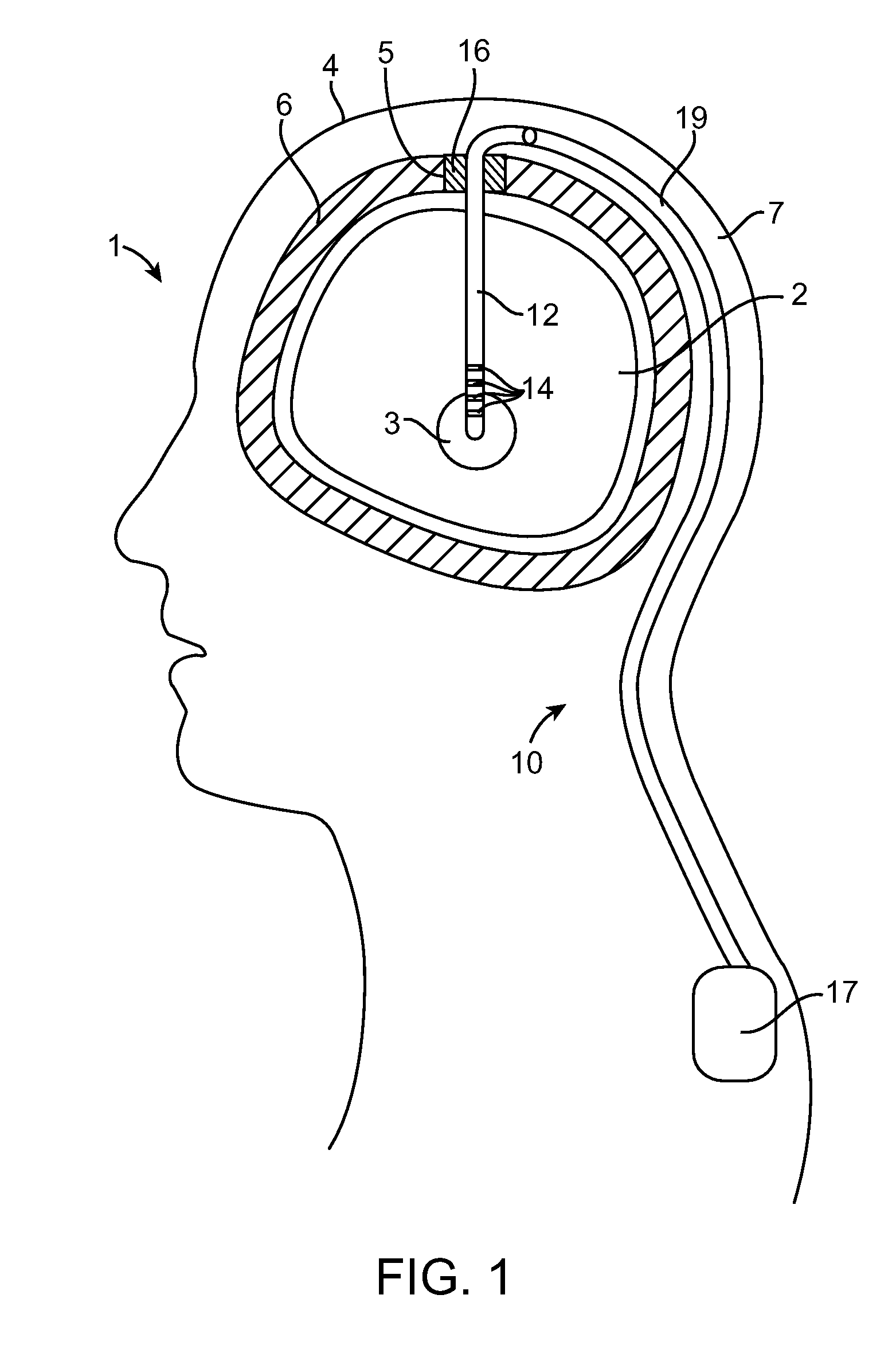 Burr hole plug designs