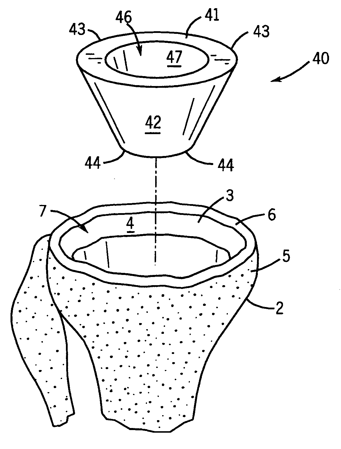 Prosthetic implant support structure