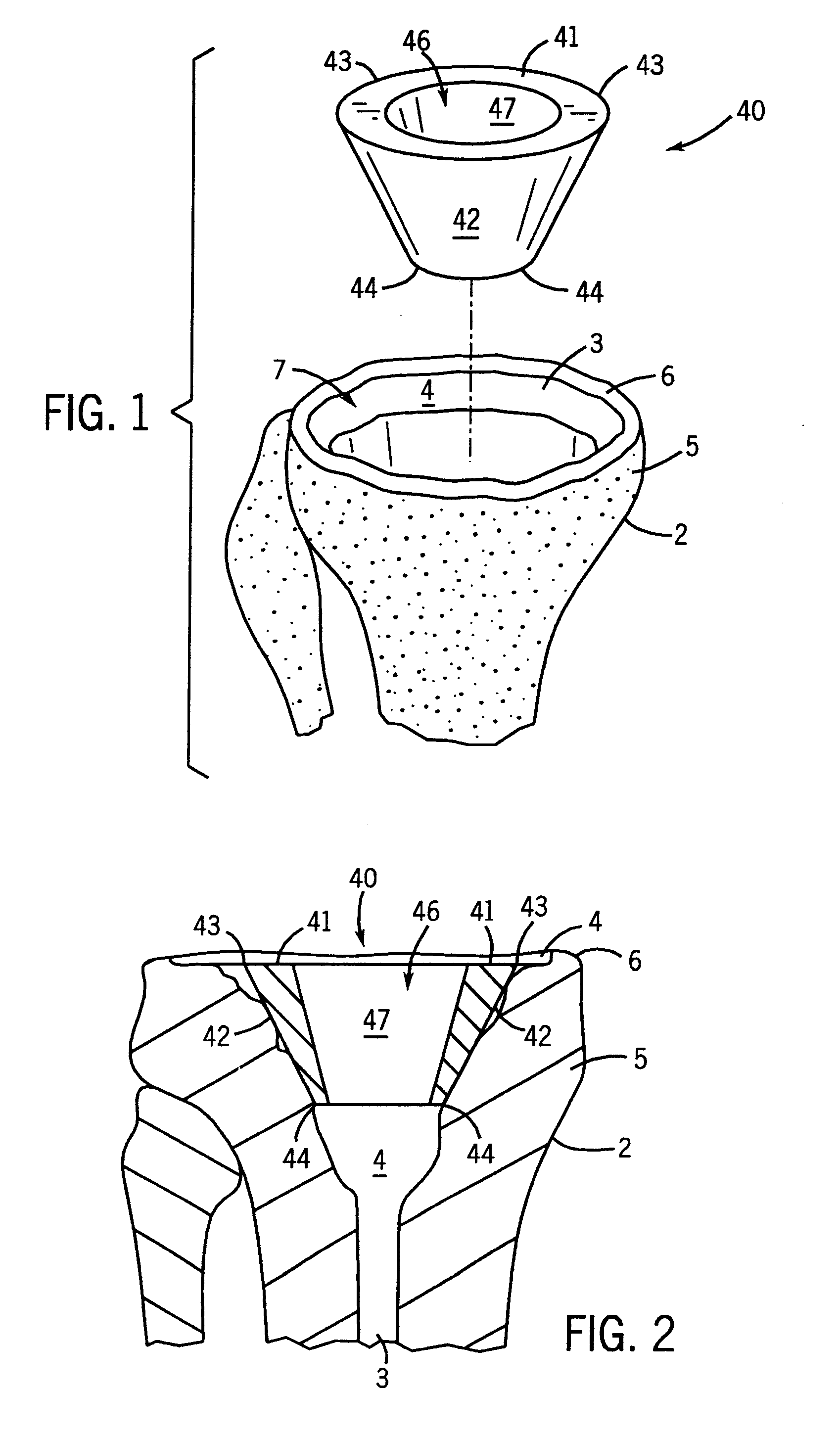 Prosthetic implant support structure