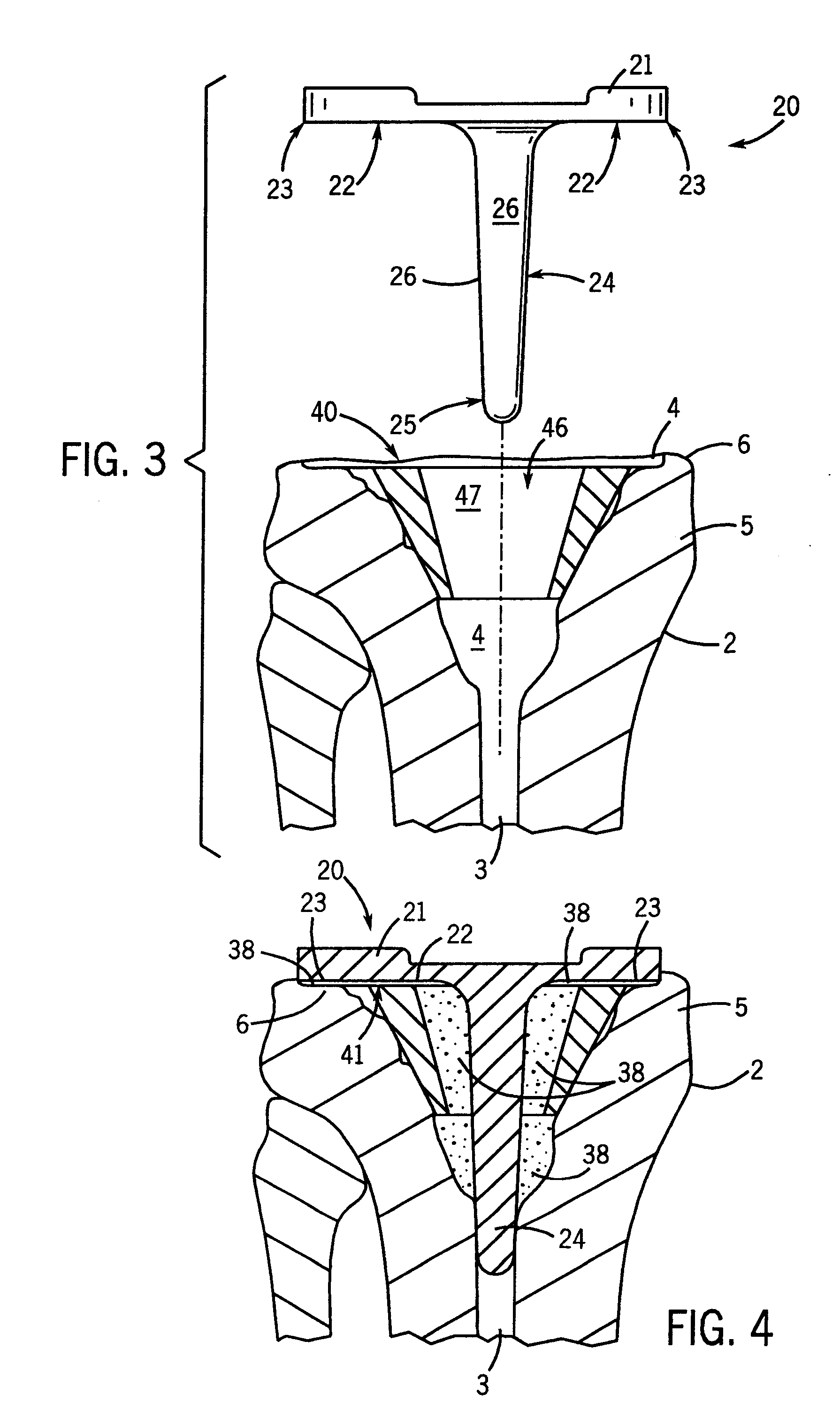 Prosthetic implant support structure