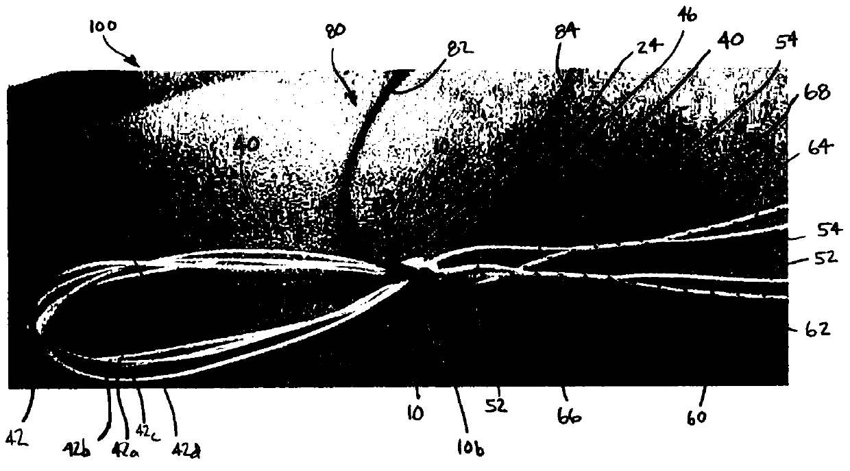 Implant with filament extension of adjustable loop disposed in shuttle suture