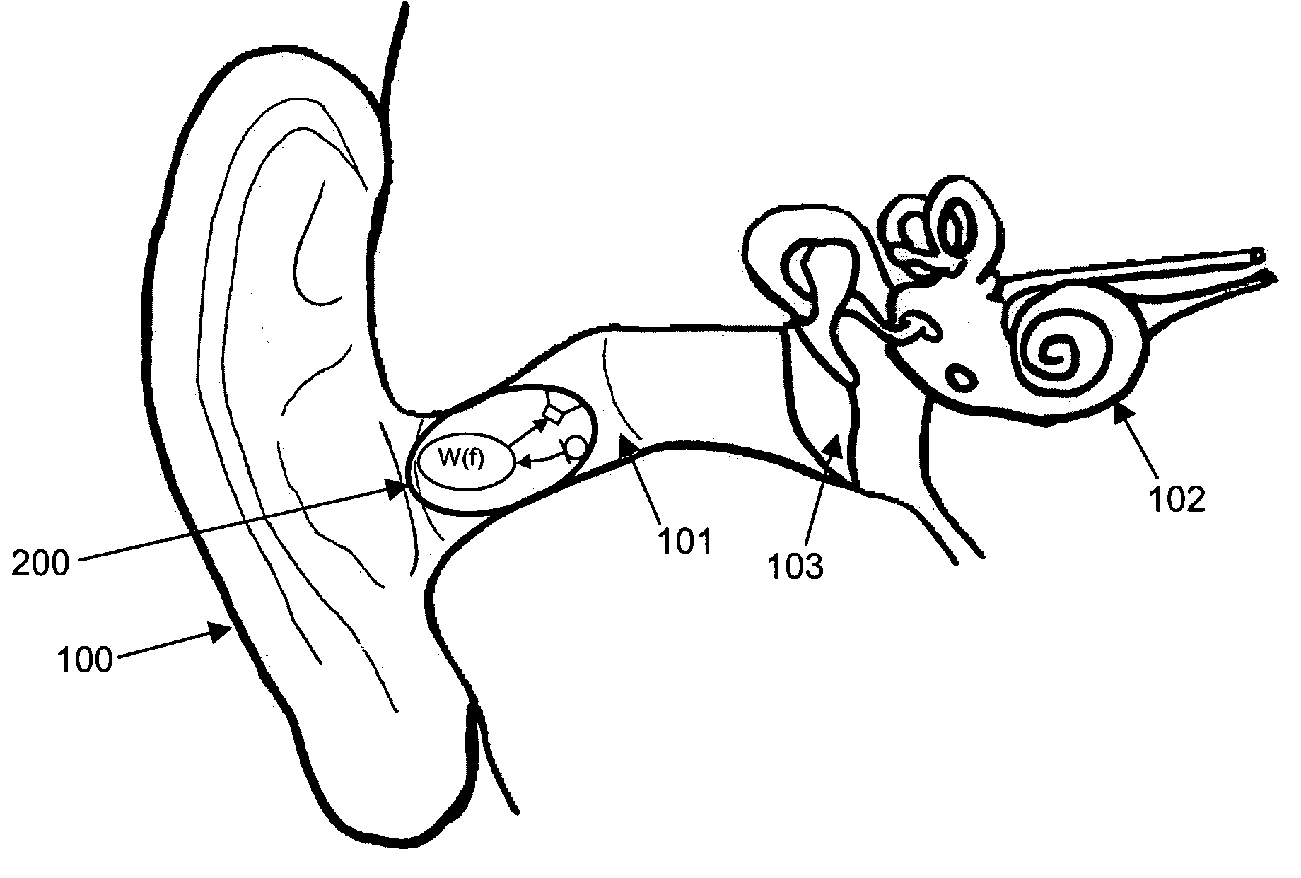 Suppression of tinnitus