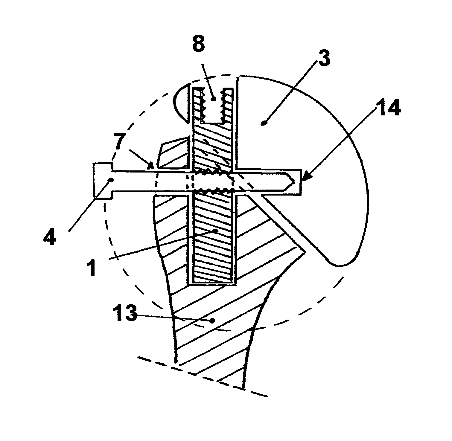 Shoulder prosthesis with insert for locking screws