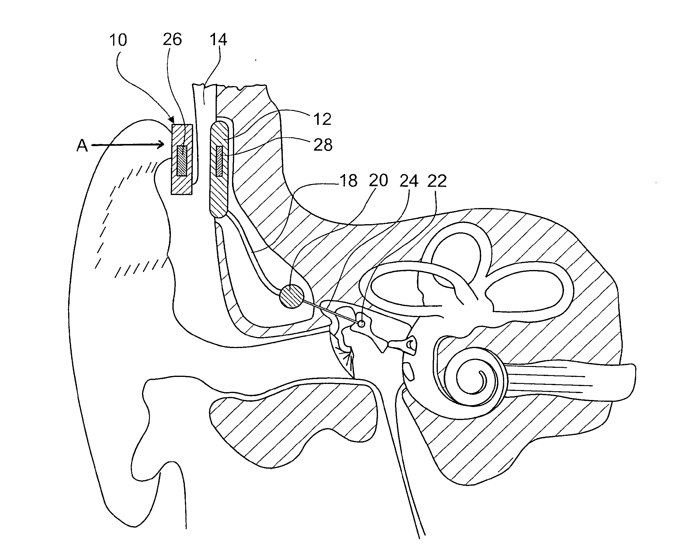 Rechargeable partially implantable hearing instrument