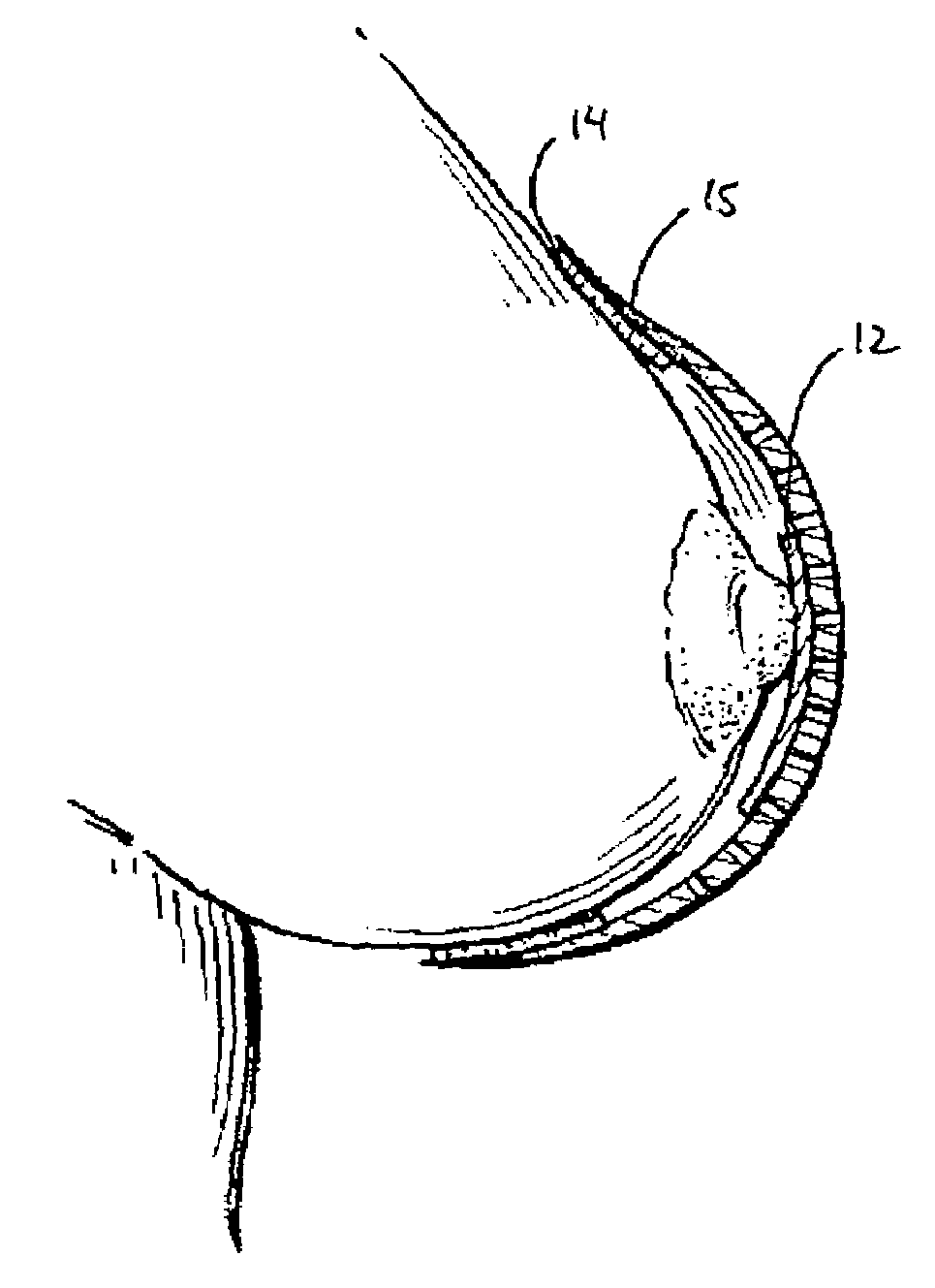 Prosthetic device