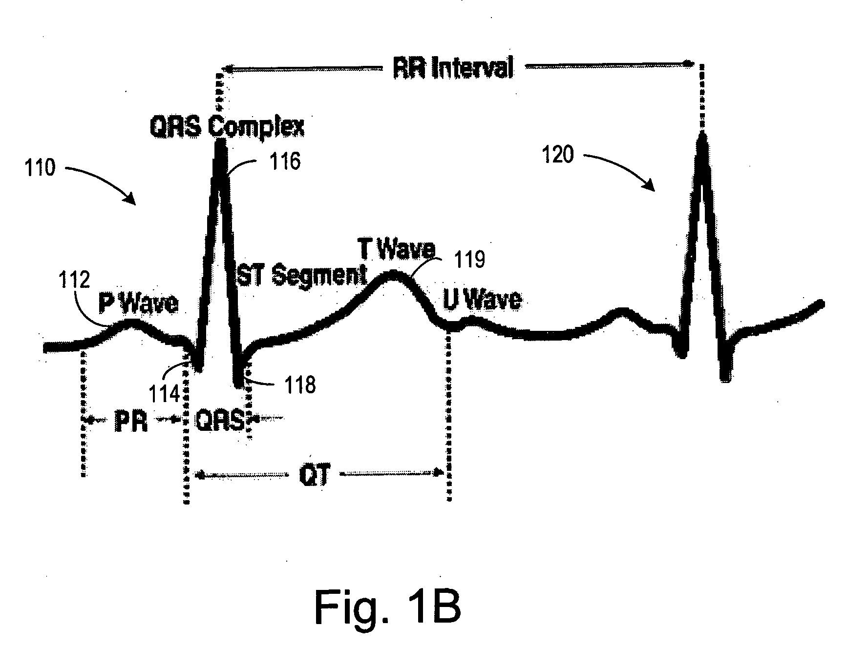 Automatic capture verification using electrocardiograms sensed from multiple implanted electrodes