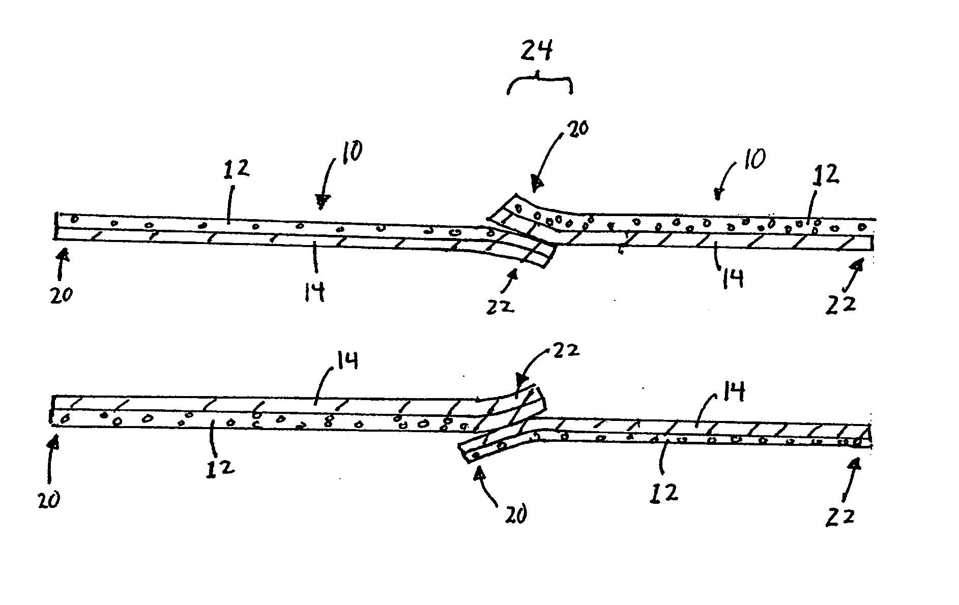 Dealloyed nanoporous stents