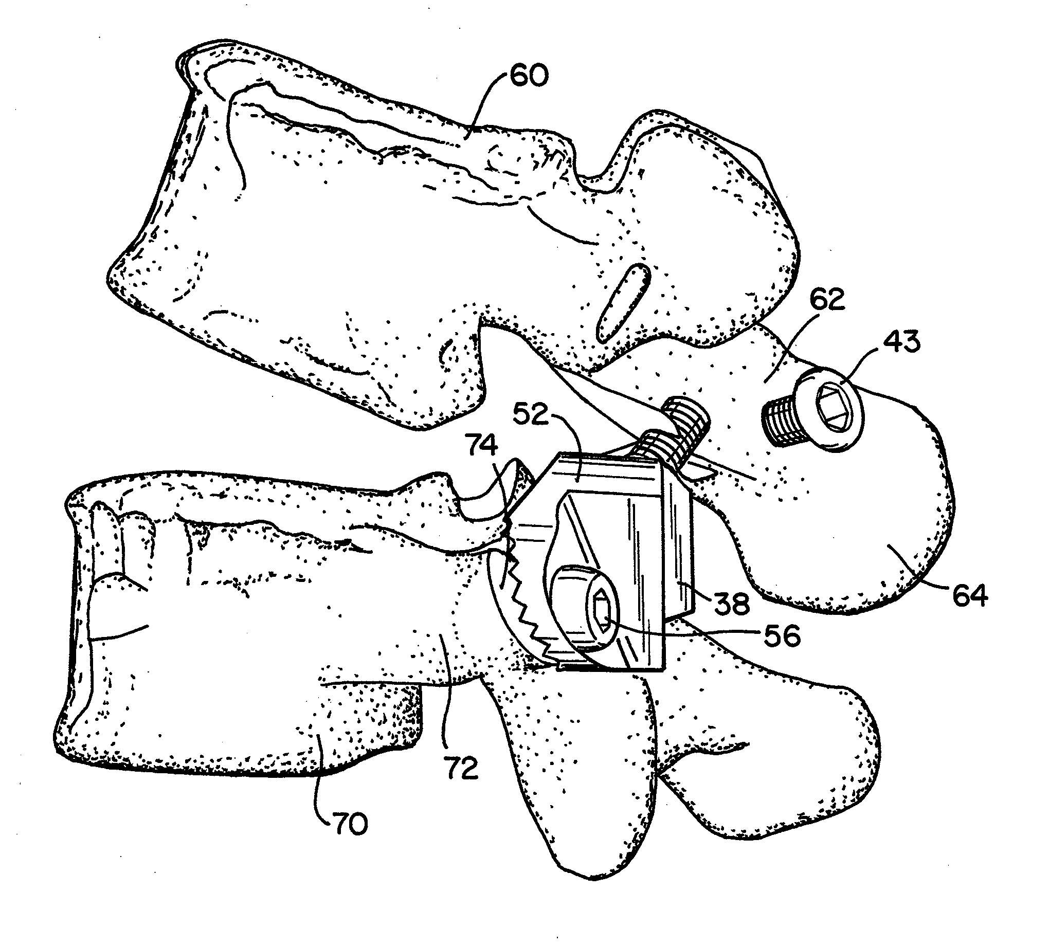 Prostheses, Tools and Methods for Replacement of Natural Facet Joints With Artificial Facet Joint Surfaces