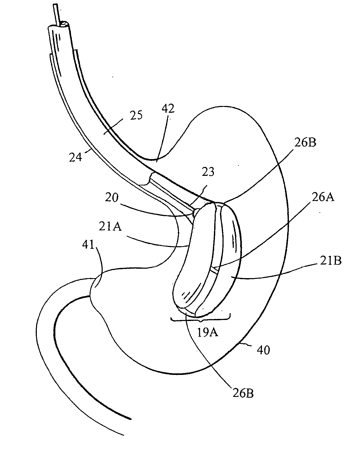 Intragastric space filler