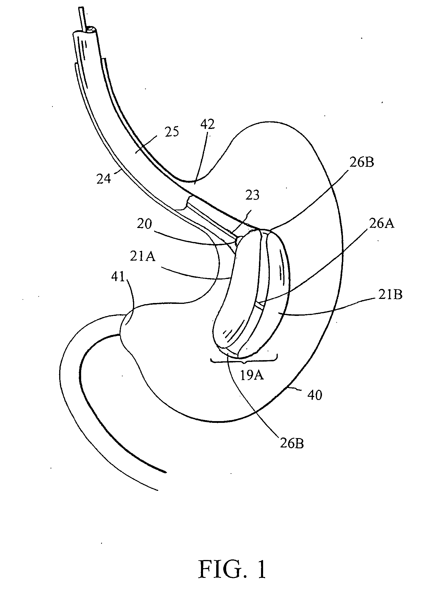 Intragastric space filler