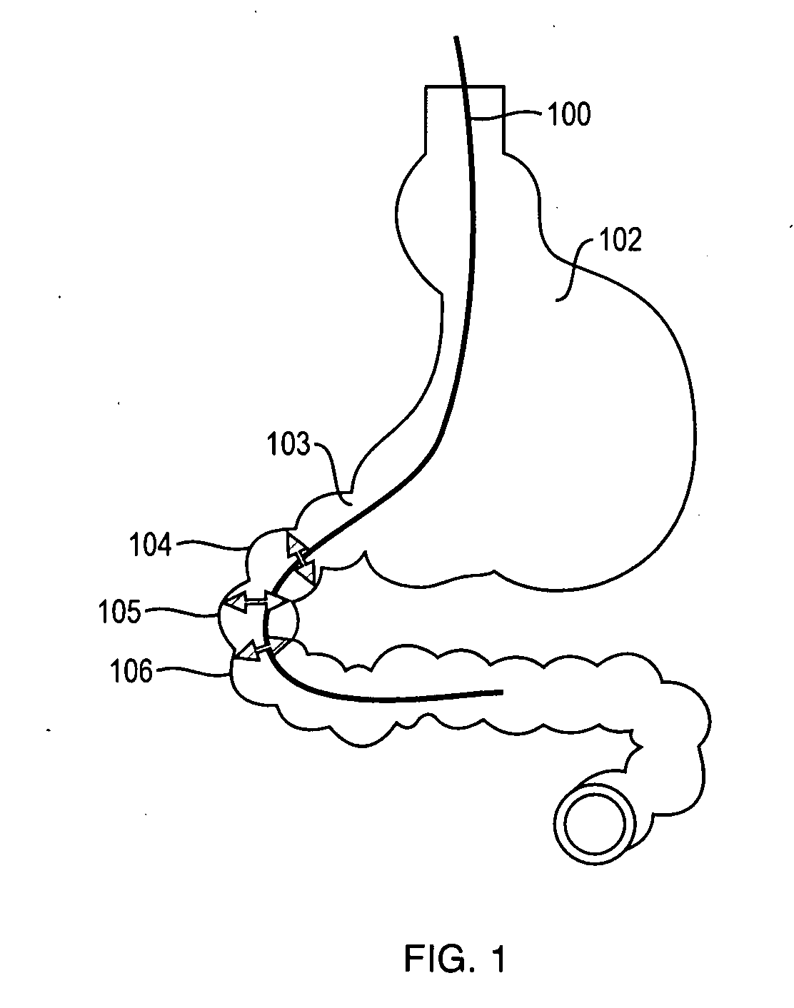 Adult and neonatal stem cell therapy to treat diabetes through the repair of the gastrointestinal tract