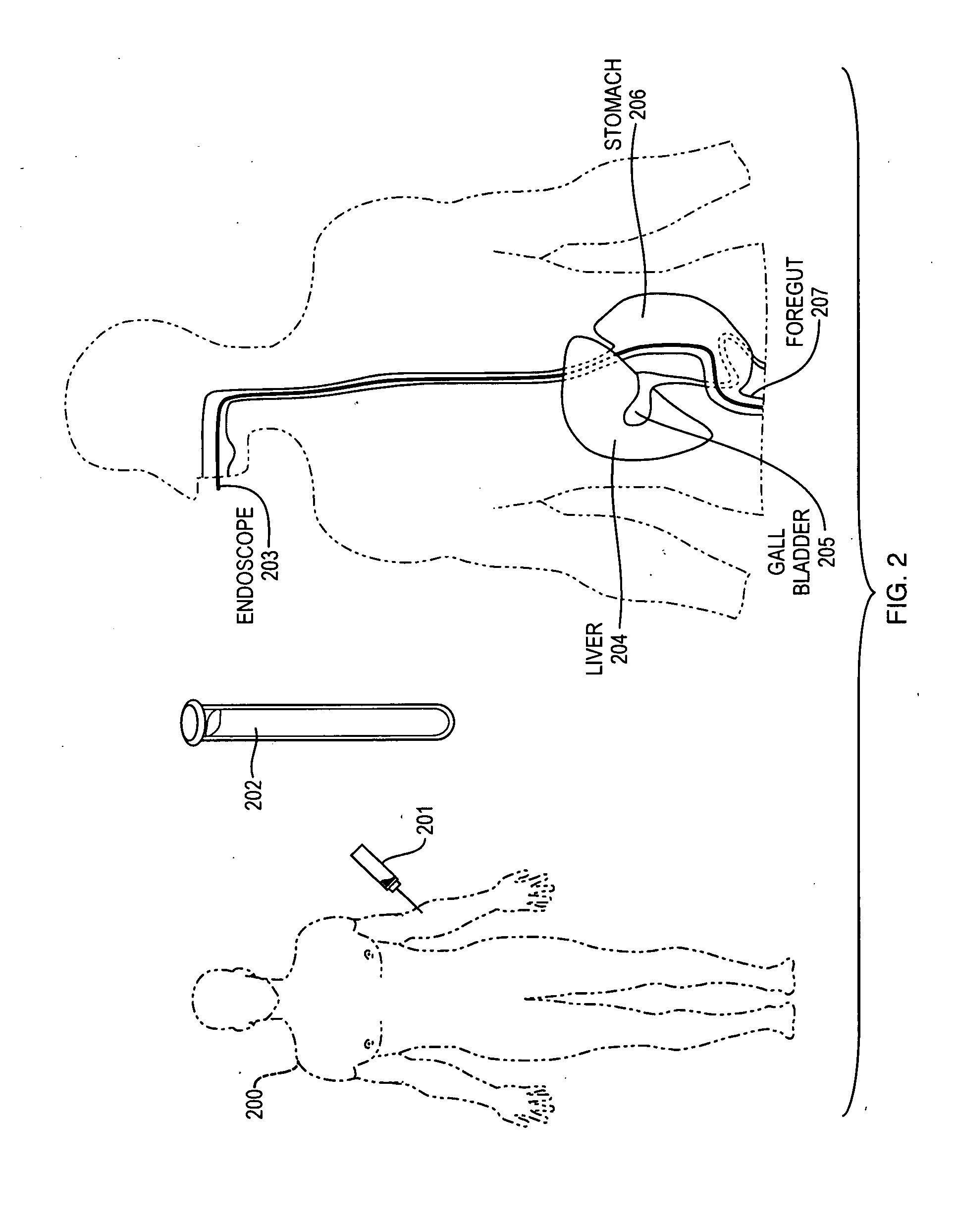 Adult and neonatal stem cell therapy to treat diabetes through the repair of the gastrointestinal tract