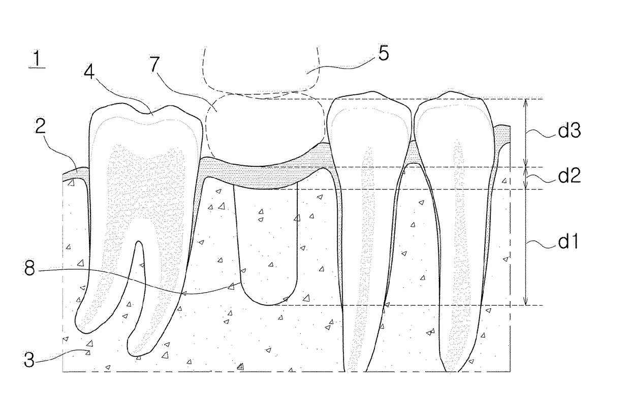 Dental implant prosthesis using digital library and method for manufacturing same