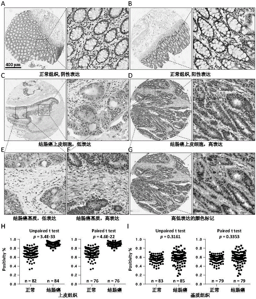 Human colorectal carcinoma molecular marker COL3A1 and application thereof