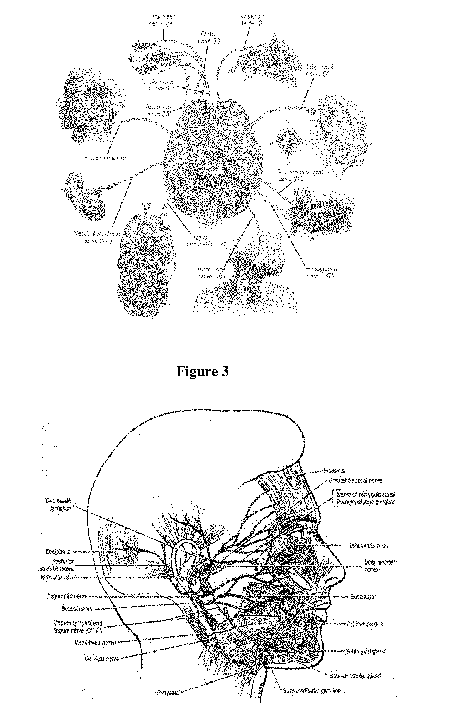 Treatment of headache