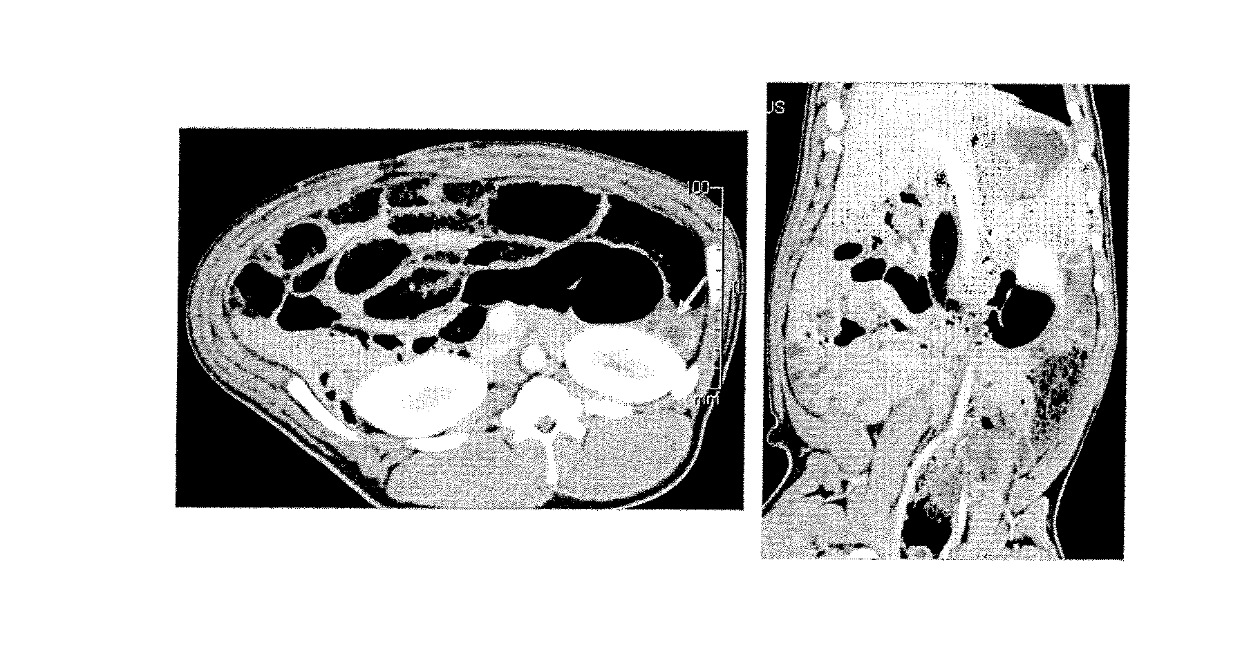 Pancreatic tumour treatment