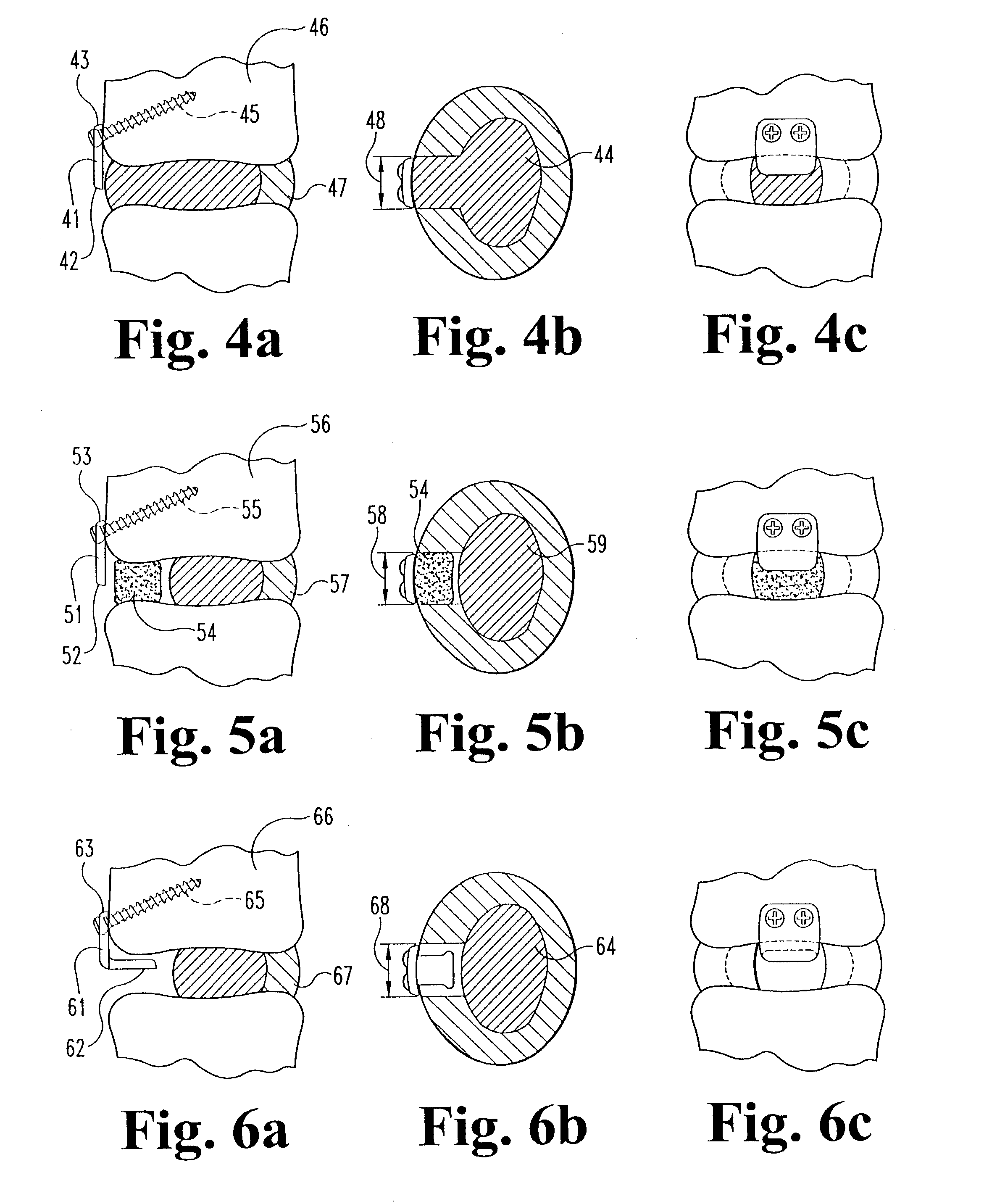 System and method for blocking and/or retaining a prosthetic spinal implant