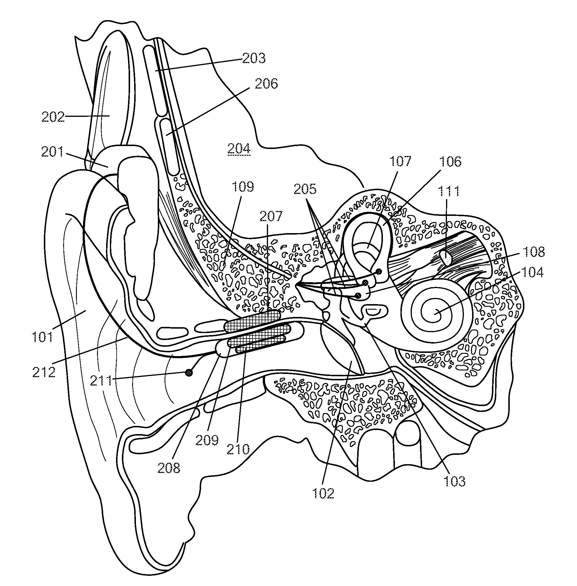 Vestibular Implant System with Internal and External Motion Sensors