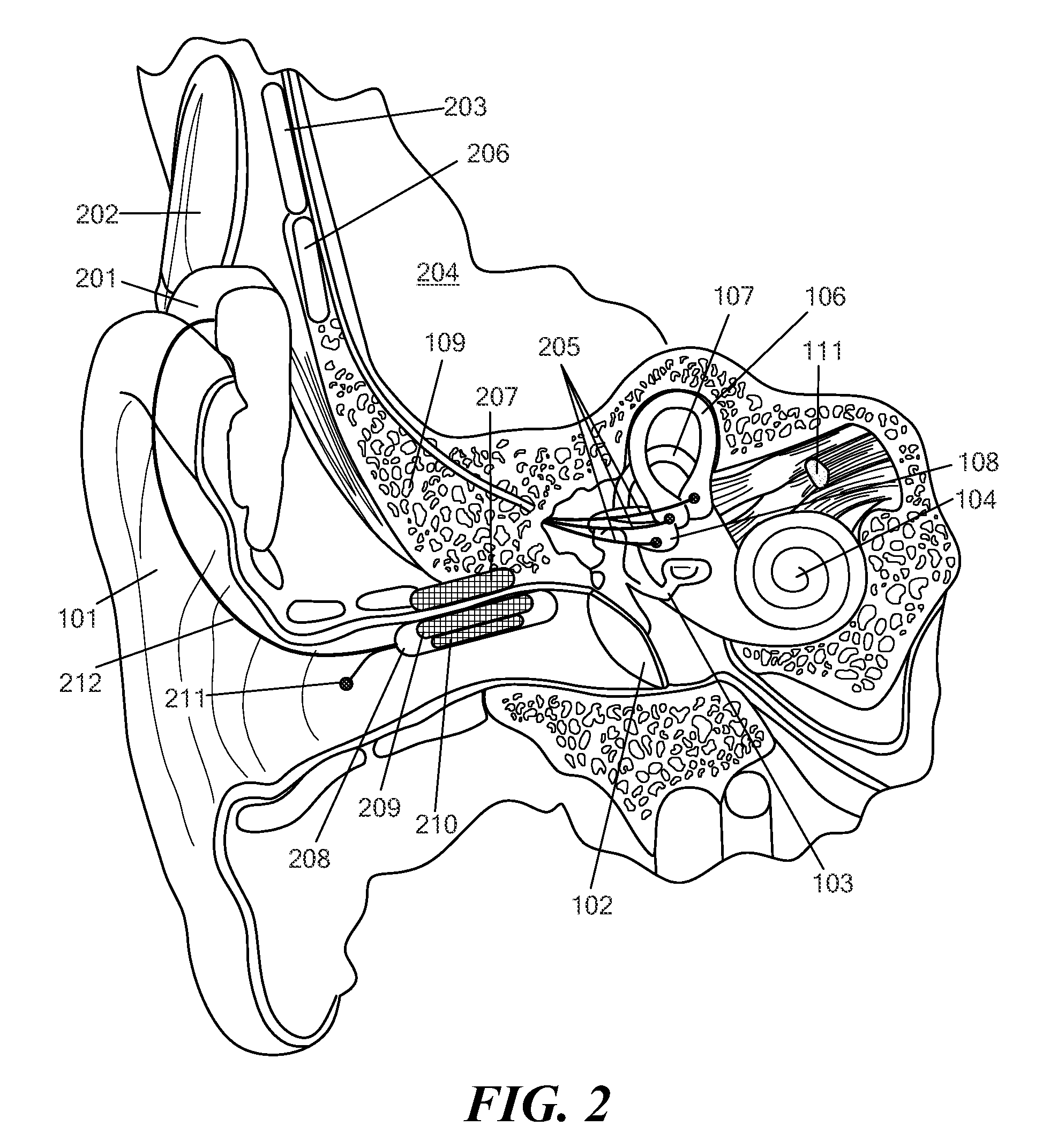 Vestibular Implant System with Internal and External Motion Sensors