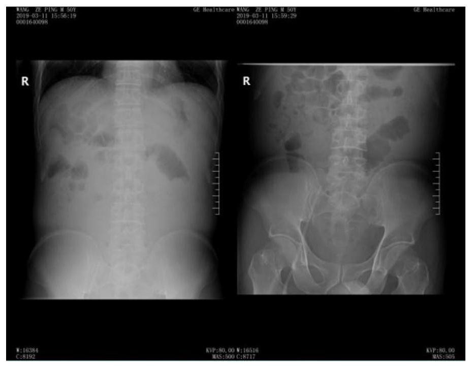 Application of terlipressin in preparation of drugs for treating dynamic intestinal obstruction