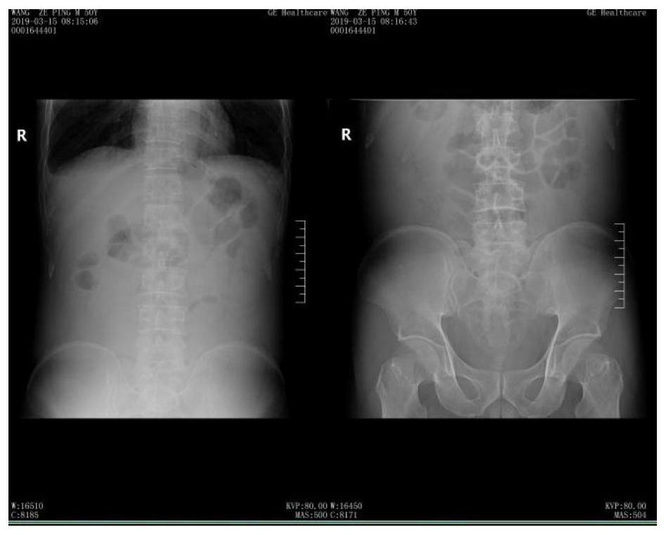 Application of terlipressin in preparation of drugs for treating dynamic intestinal obstruction