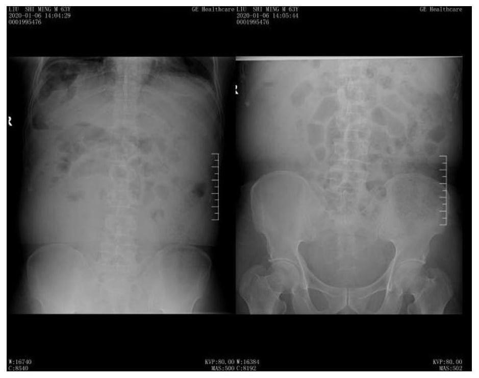 Application of terlipressin in preparation of drugs for treating dynamic intestinal obstruction