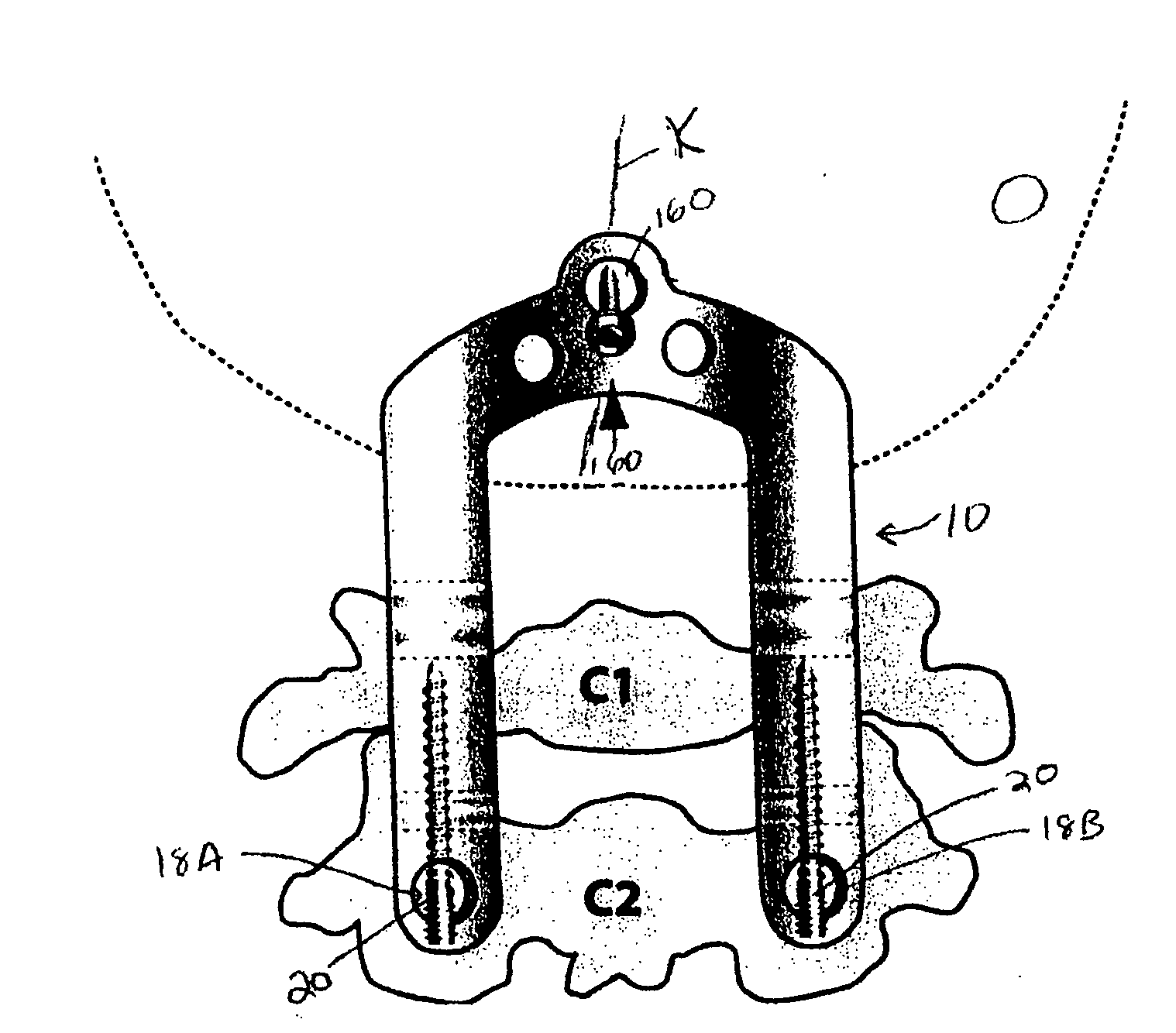 Occipitocervical plate