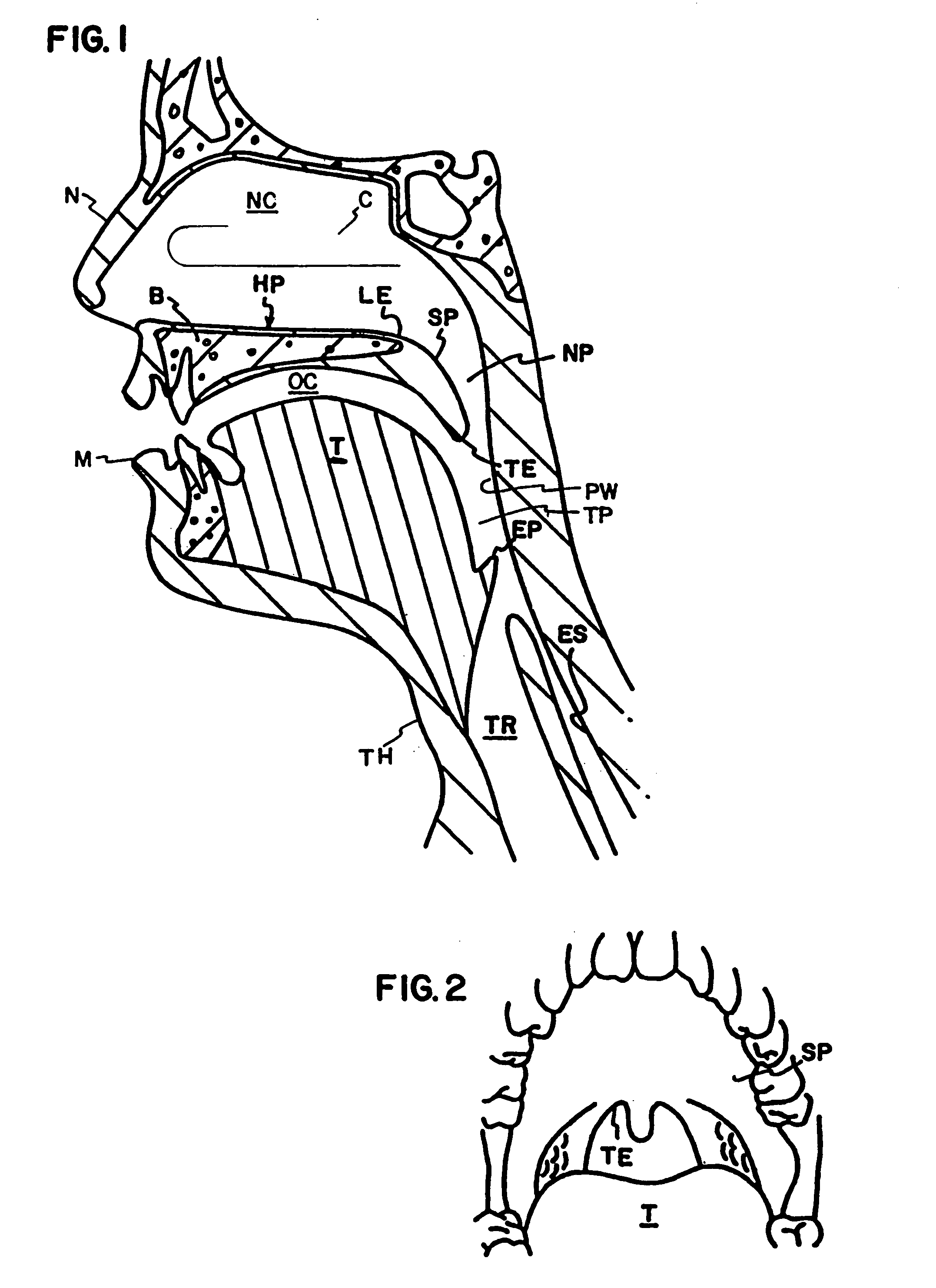 Method and apparatus to treat conditions of the naso-pharyngeal area