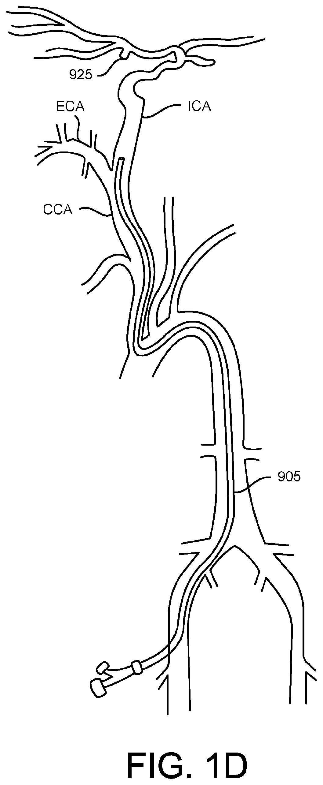 Methods of intracerebral implant delivery