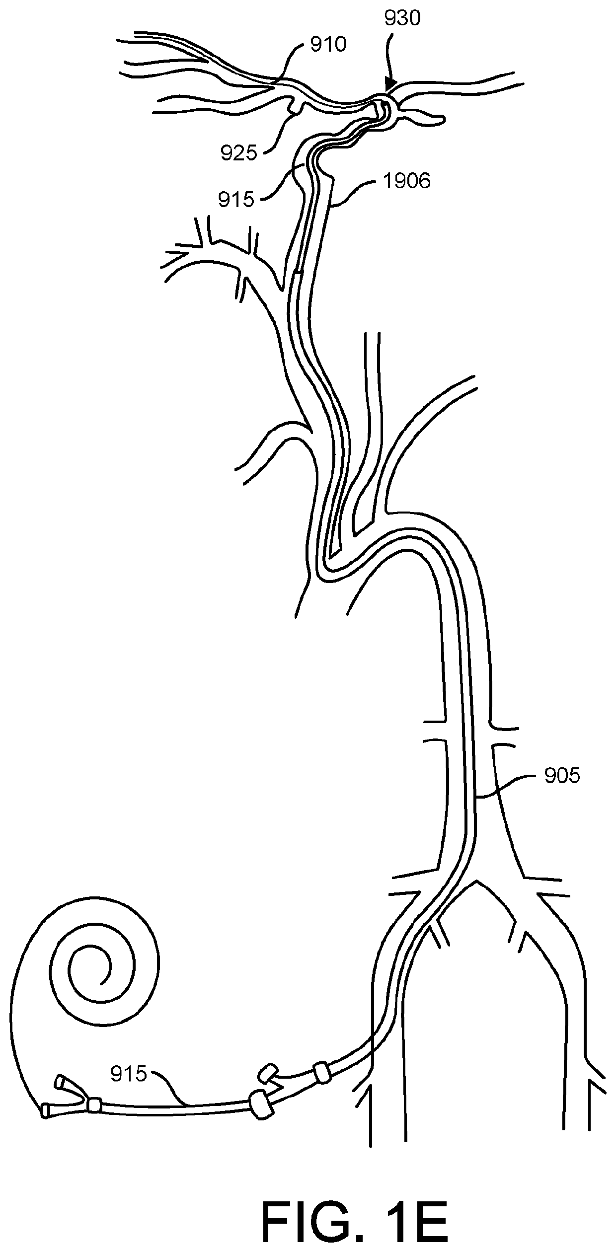 Methods of intracerebral implant delivery