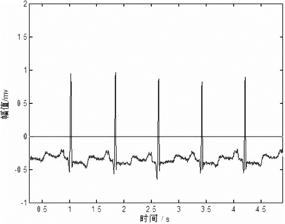 Automatic classification method for electrocardiogram signals