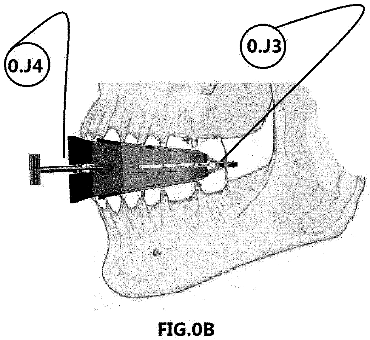 Molar Lift Oral Insertion, Disposable Attach Double Level panorama form Bristle Brush Tilter