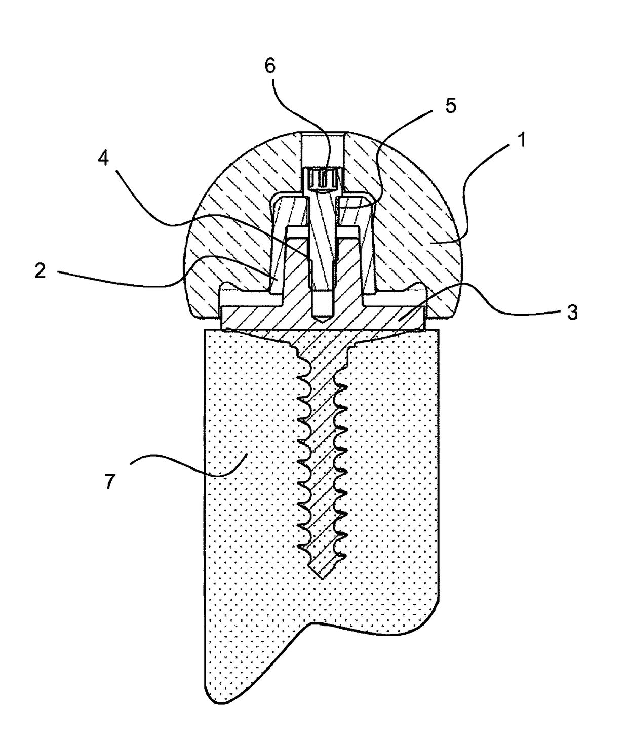 Fastening ceramic components