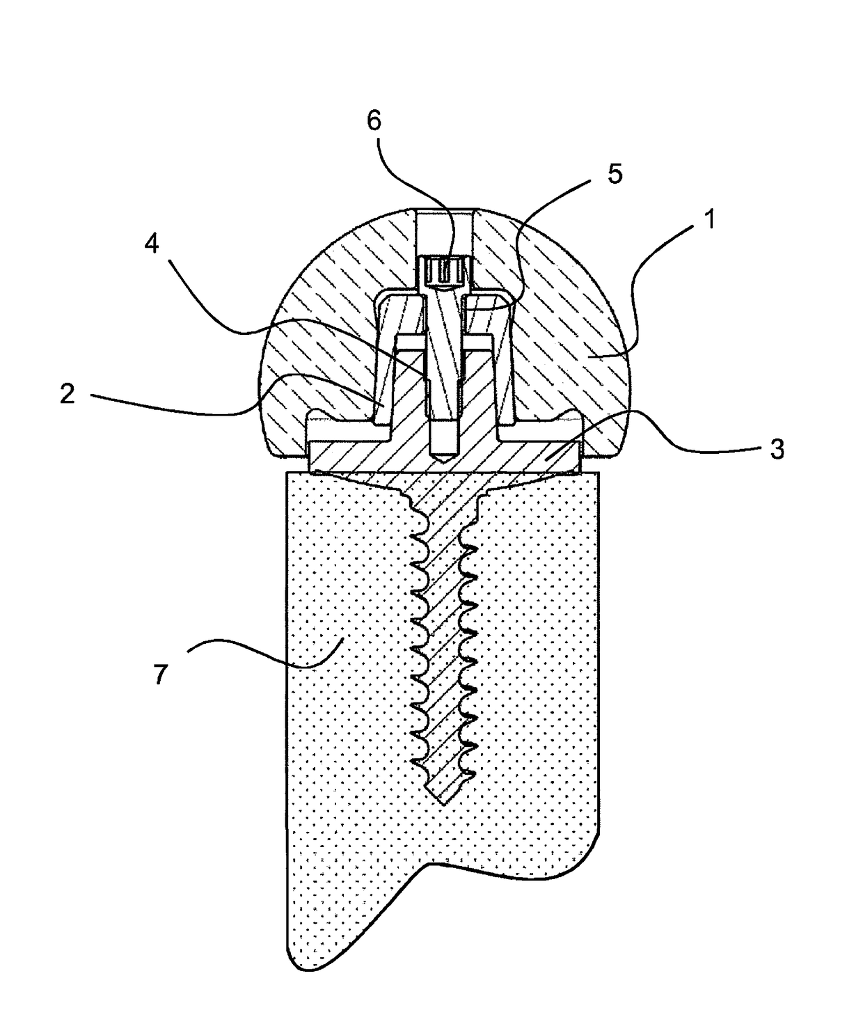 Fastening ceramic components