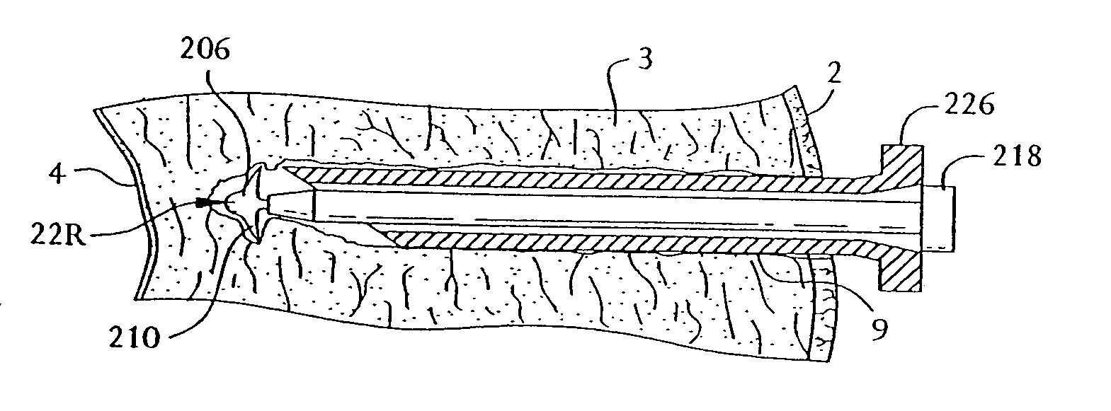 Transmyocardial revascularization system and method of use