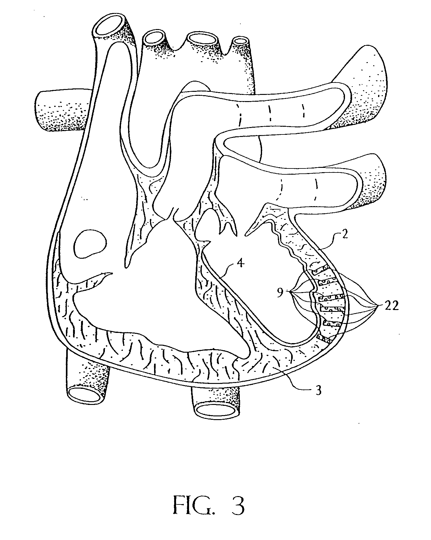 Transmyocardial revascularization system and method of use