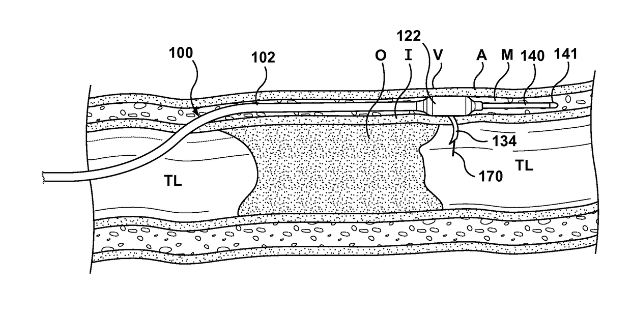 Occlusion Bypassing Apparatus With A Re-Entry Needle and a Distal Stabilization Balloon