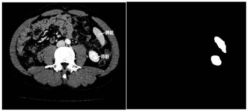 Kidney segmentation method in CT image based on deep learning