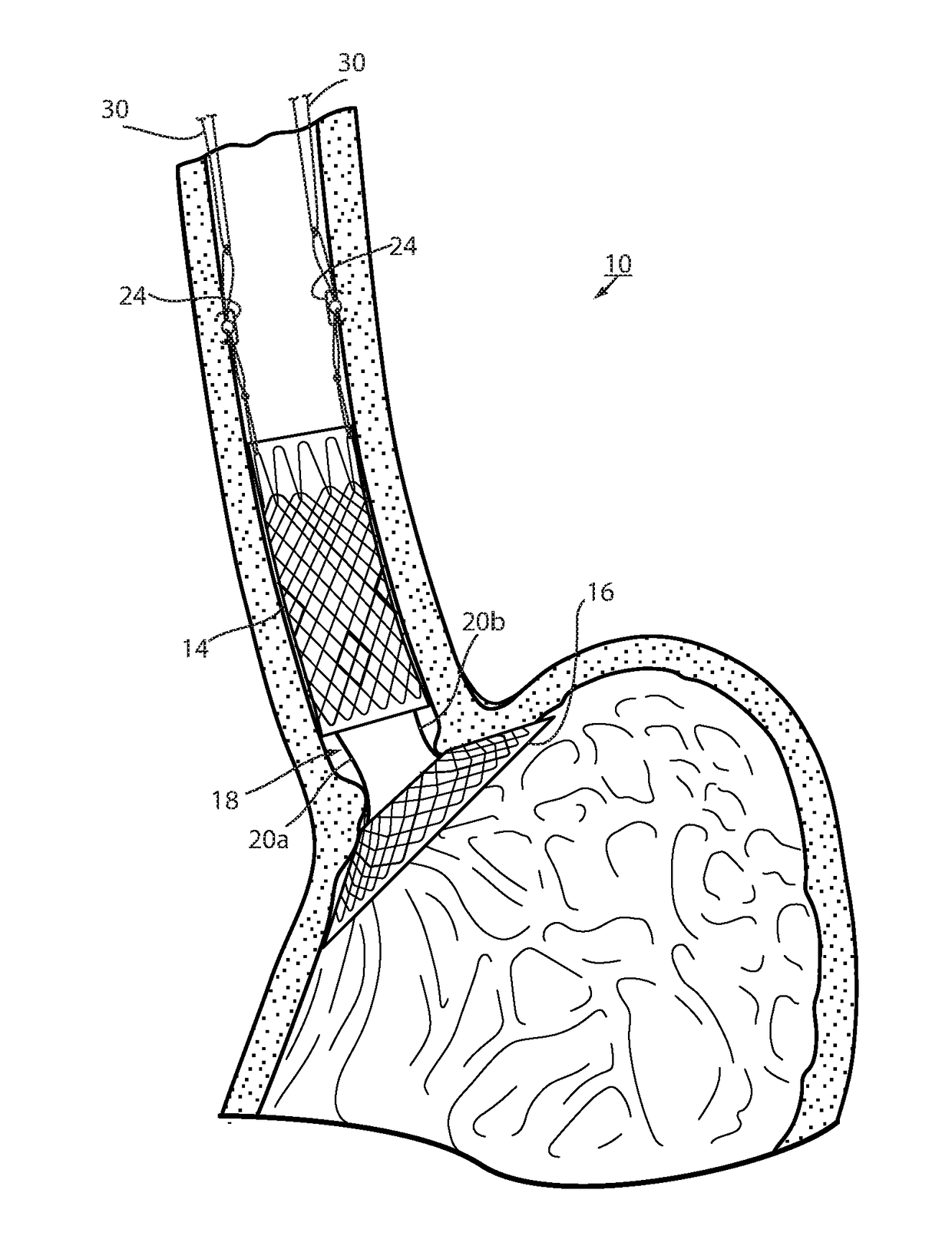 Fixation of intraluminal device