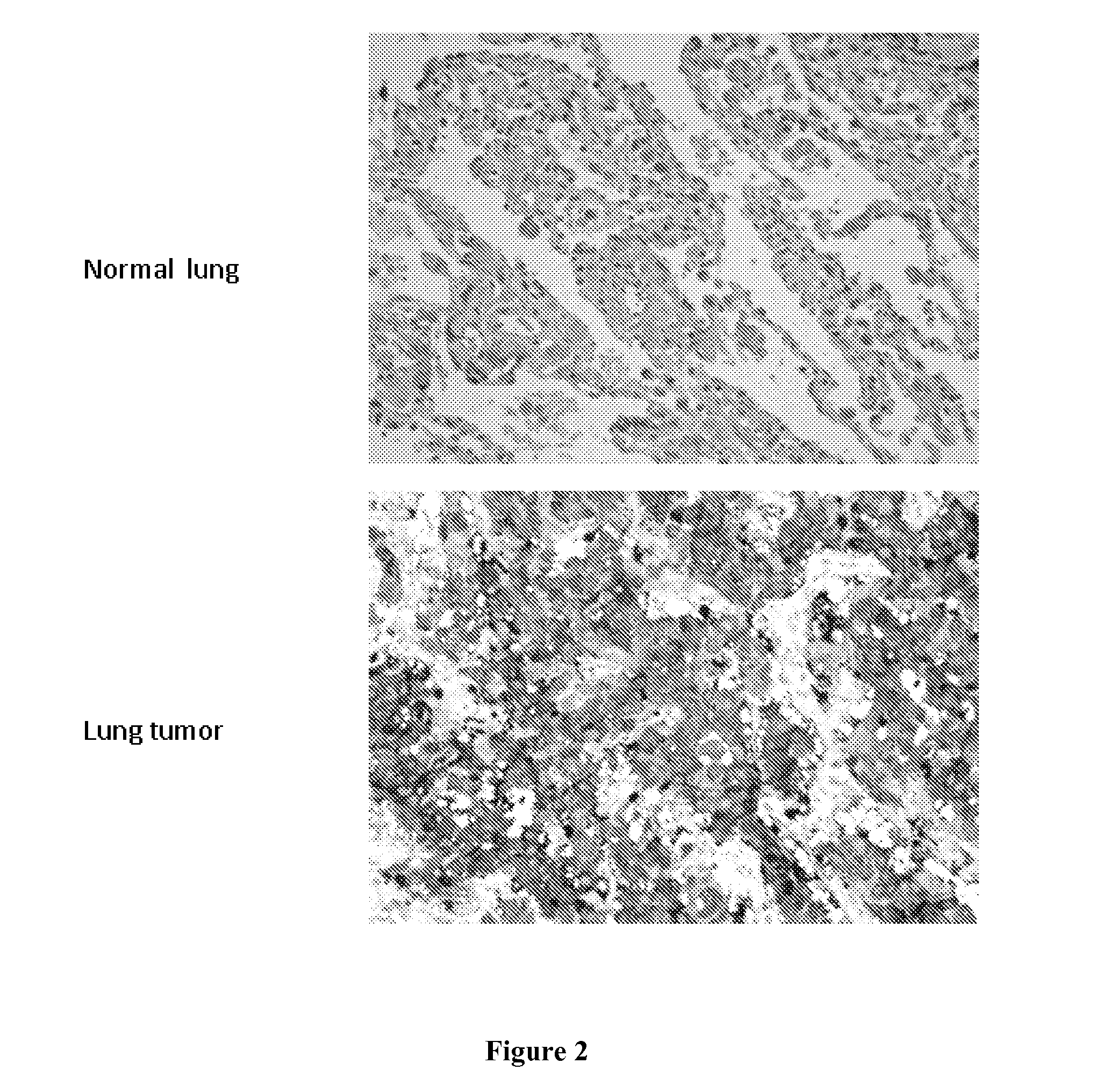 Lung Tumor Markers and Methods of Use Thereof