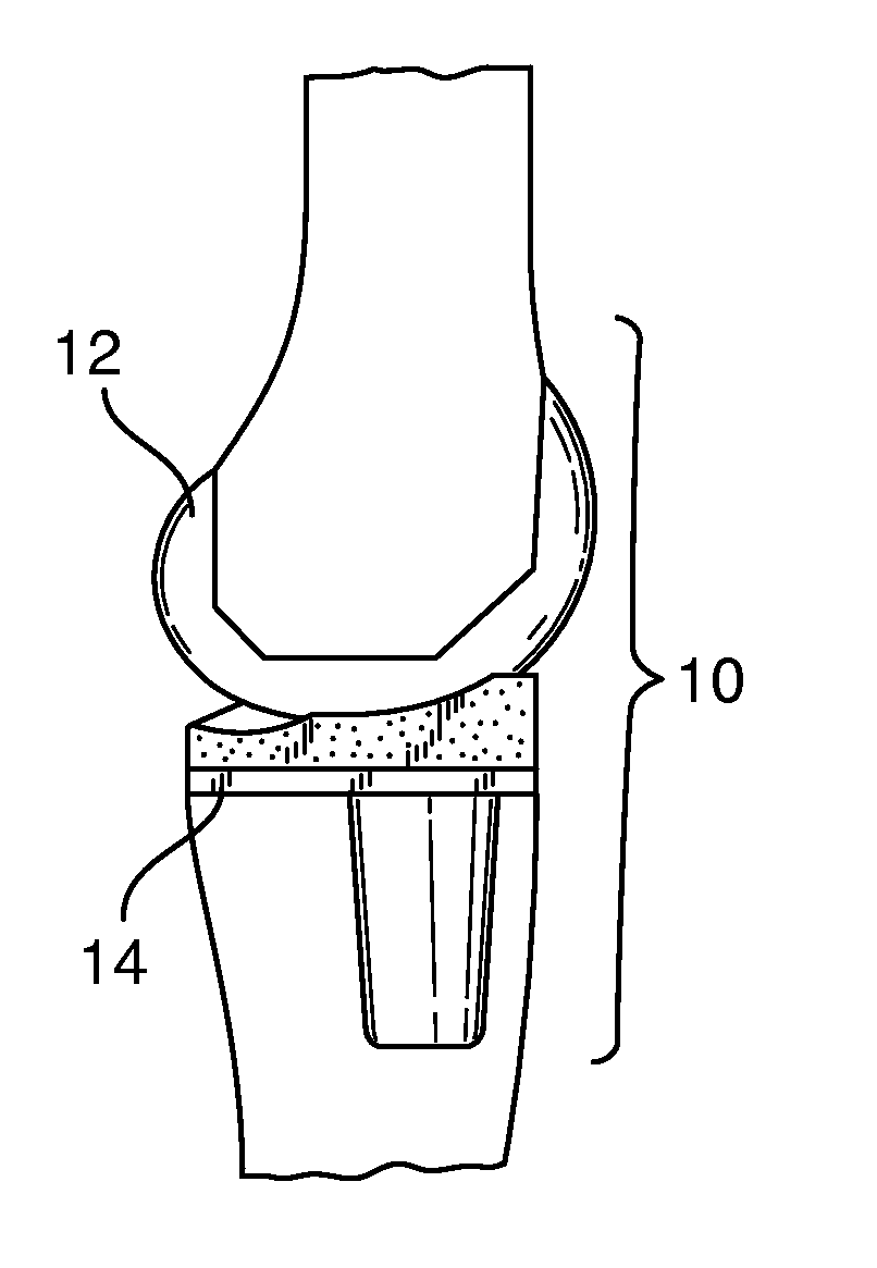 Systems and methods for providing a femoral resection block