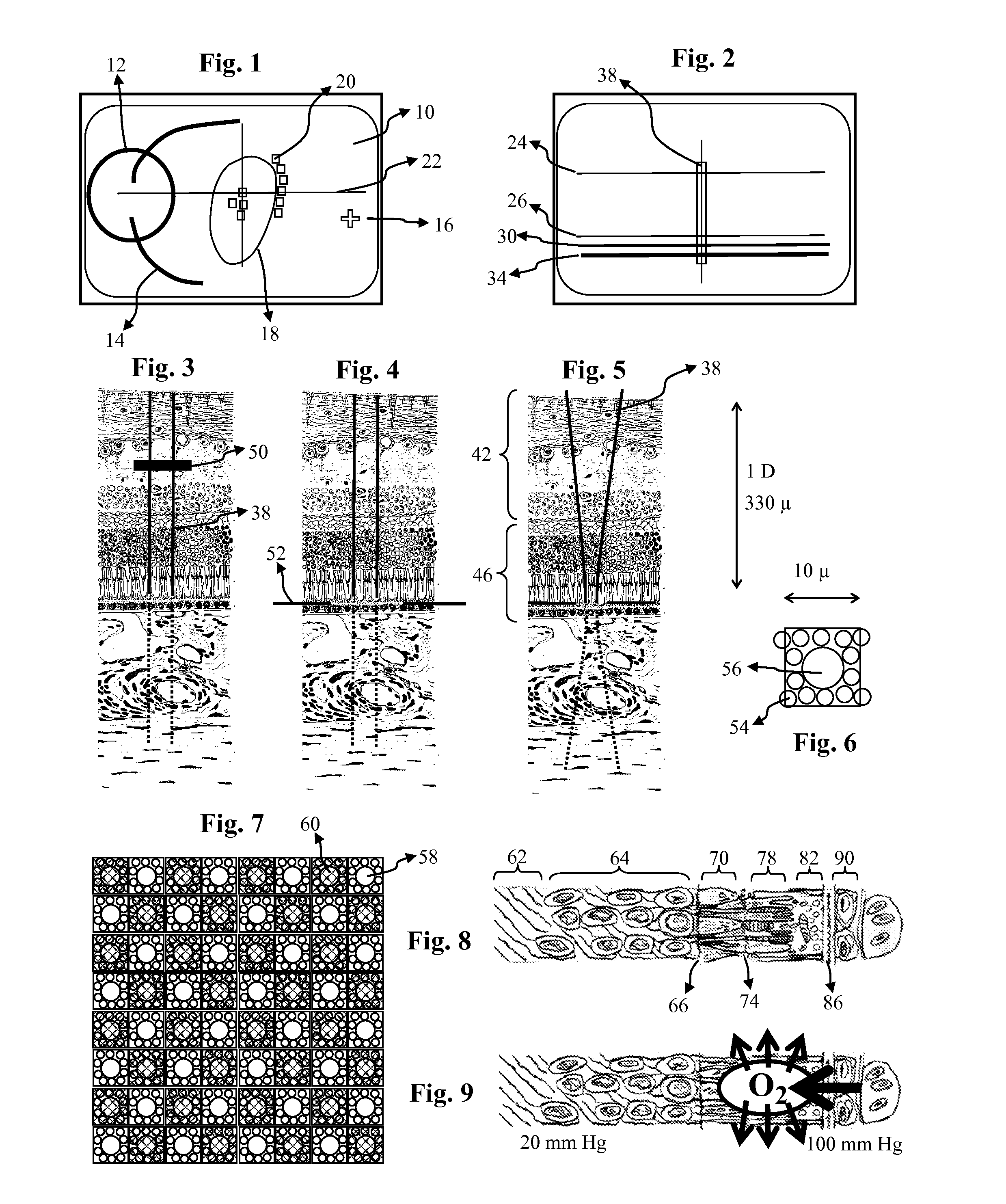 Femtosecond laser apparatus for plasma induced vitreous ablation in the eye