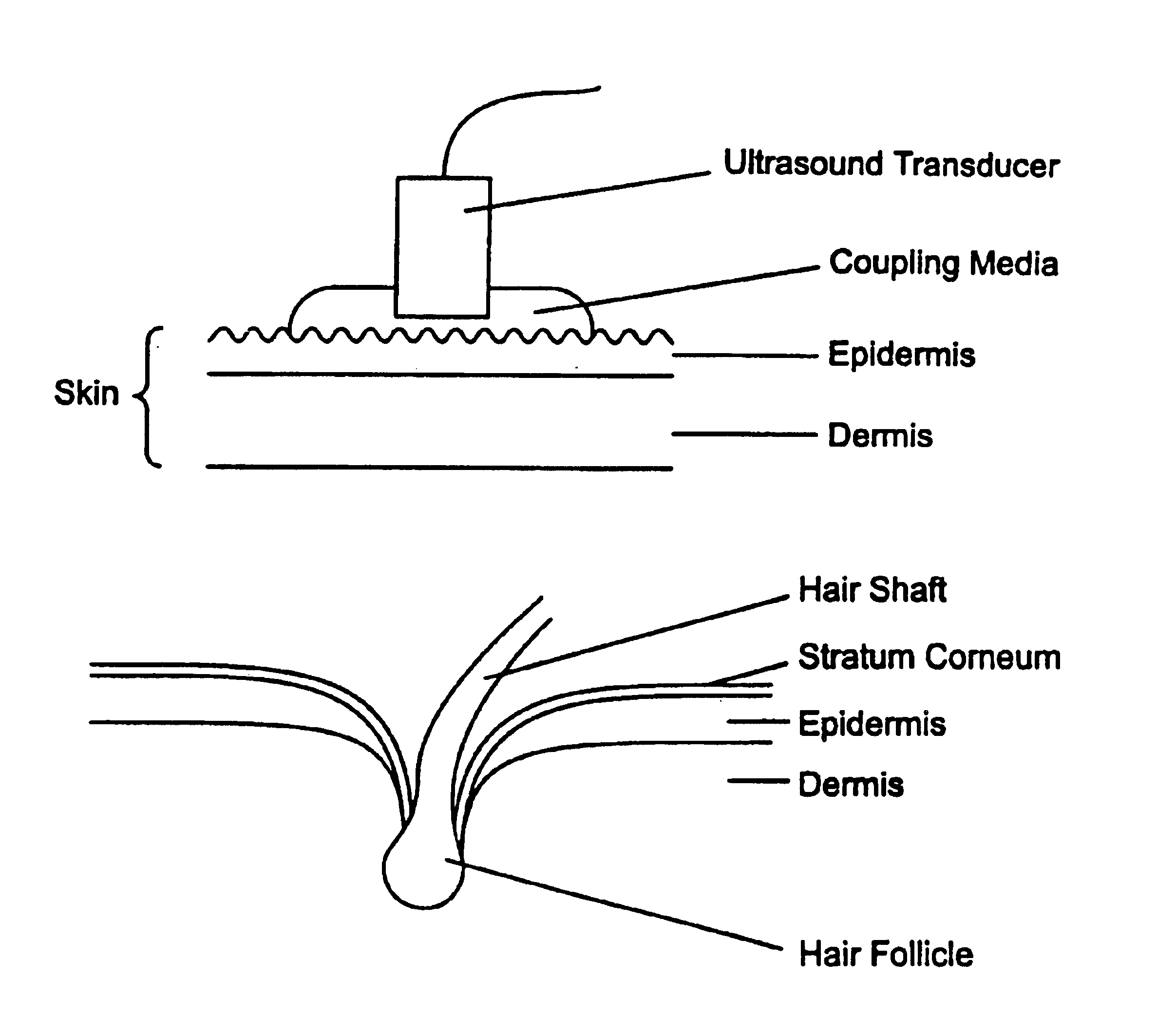 Ultrasound enhancement of percutaneous drug absorption