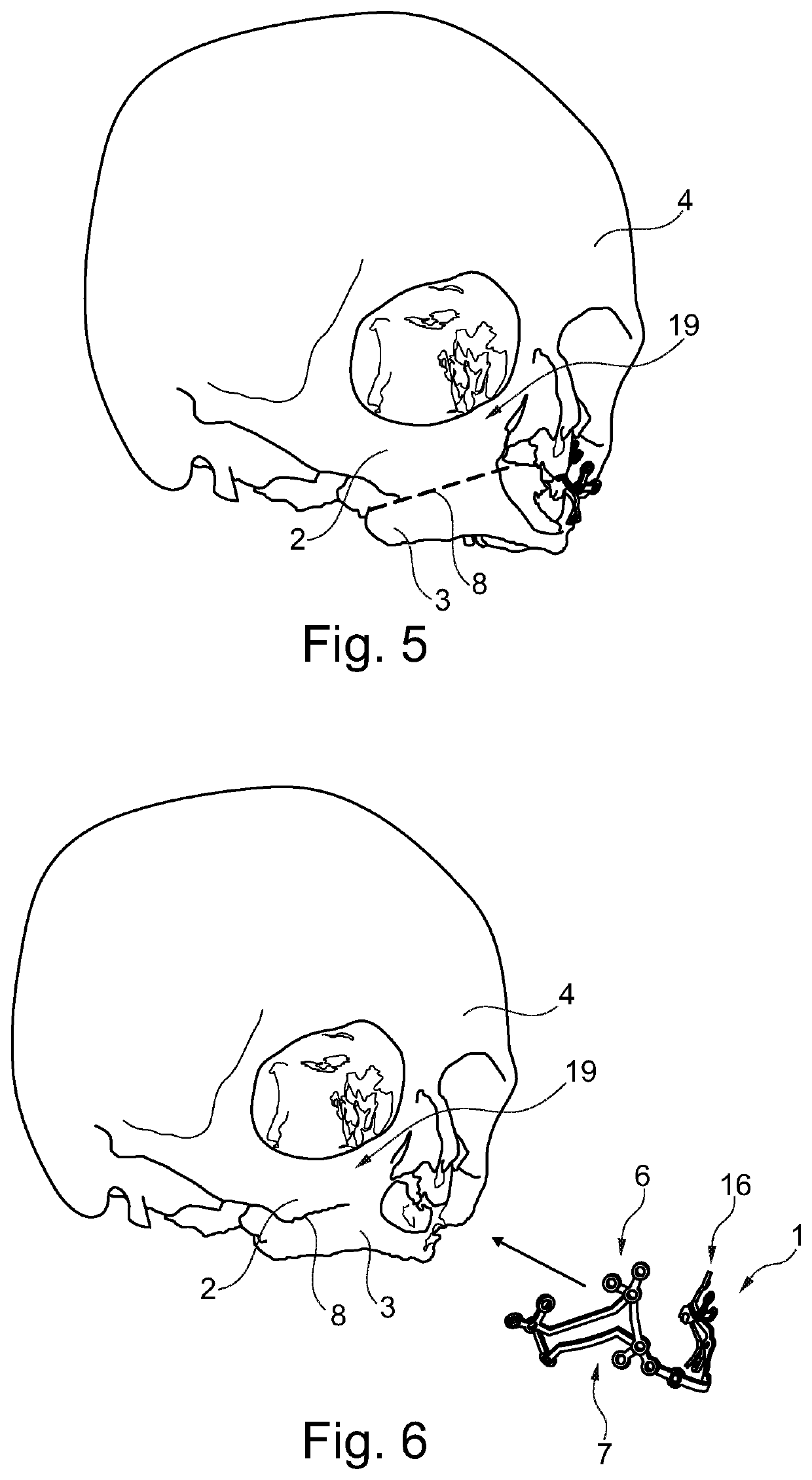 Orthognathic saw and positioning implant