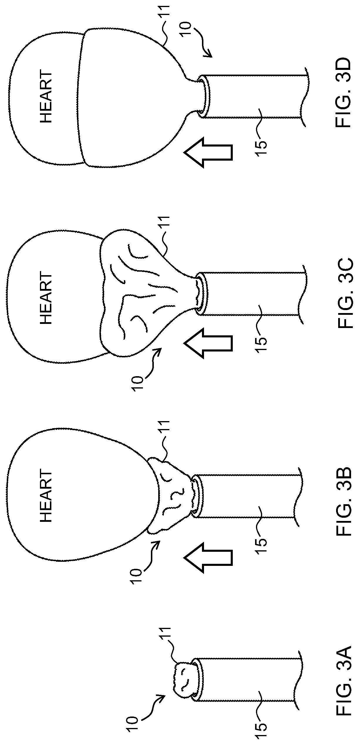 Cardiac output support apparatus