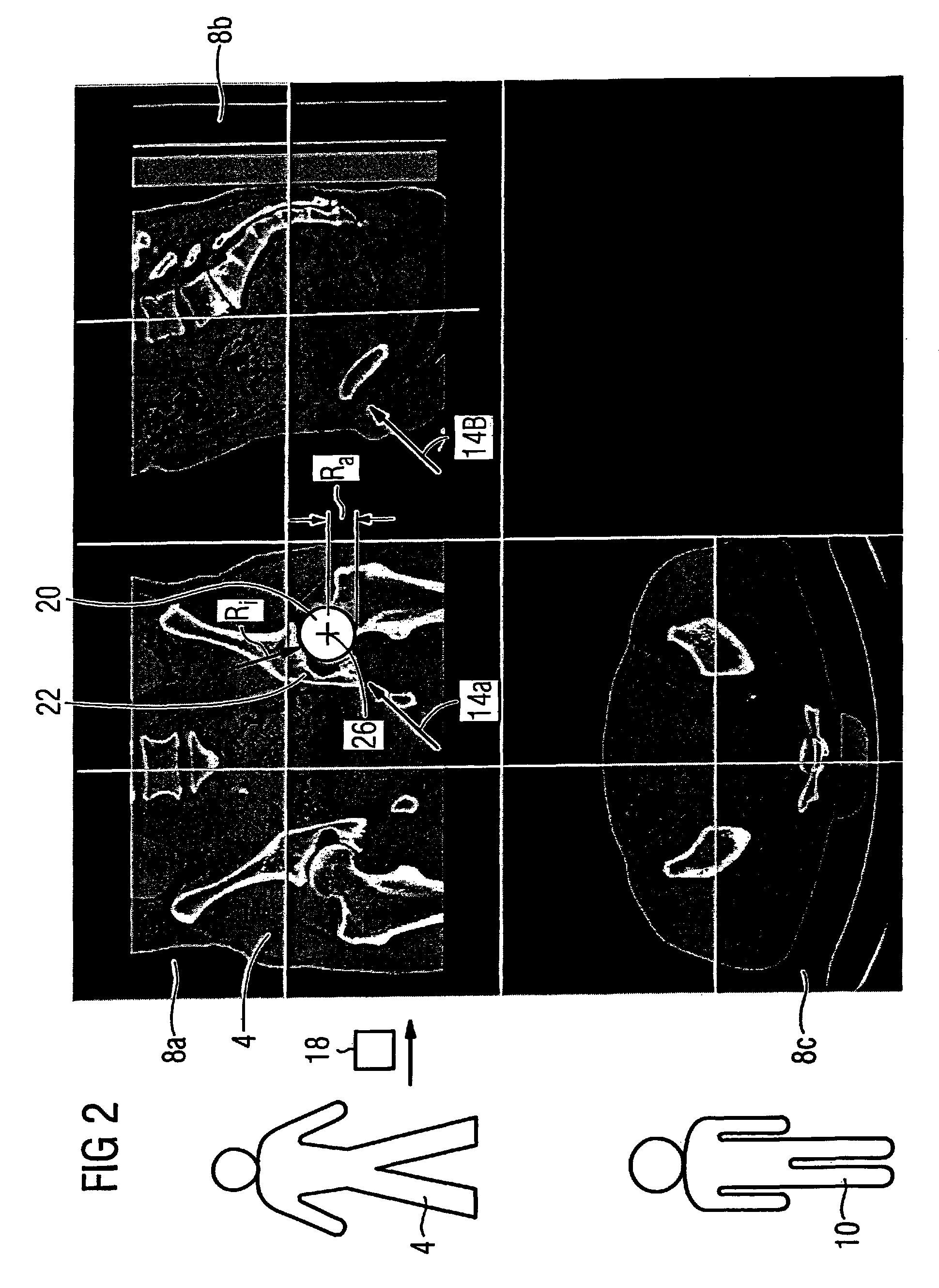 Method for virtual adaptation of an implant to a body part of a patient